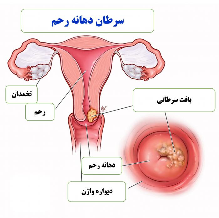 سرطان دهانه رحم (CERVICAL CANCER)